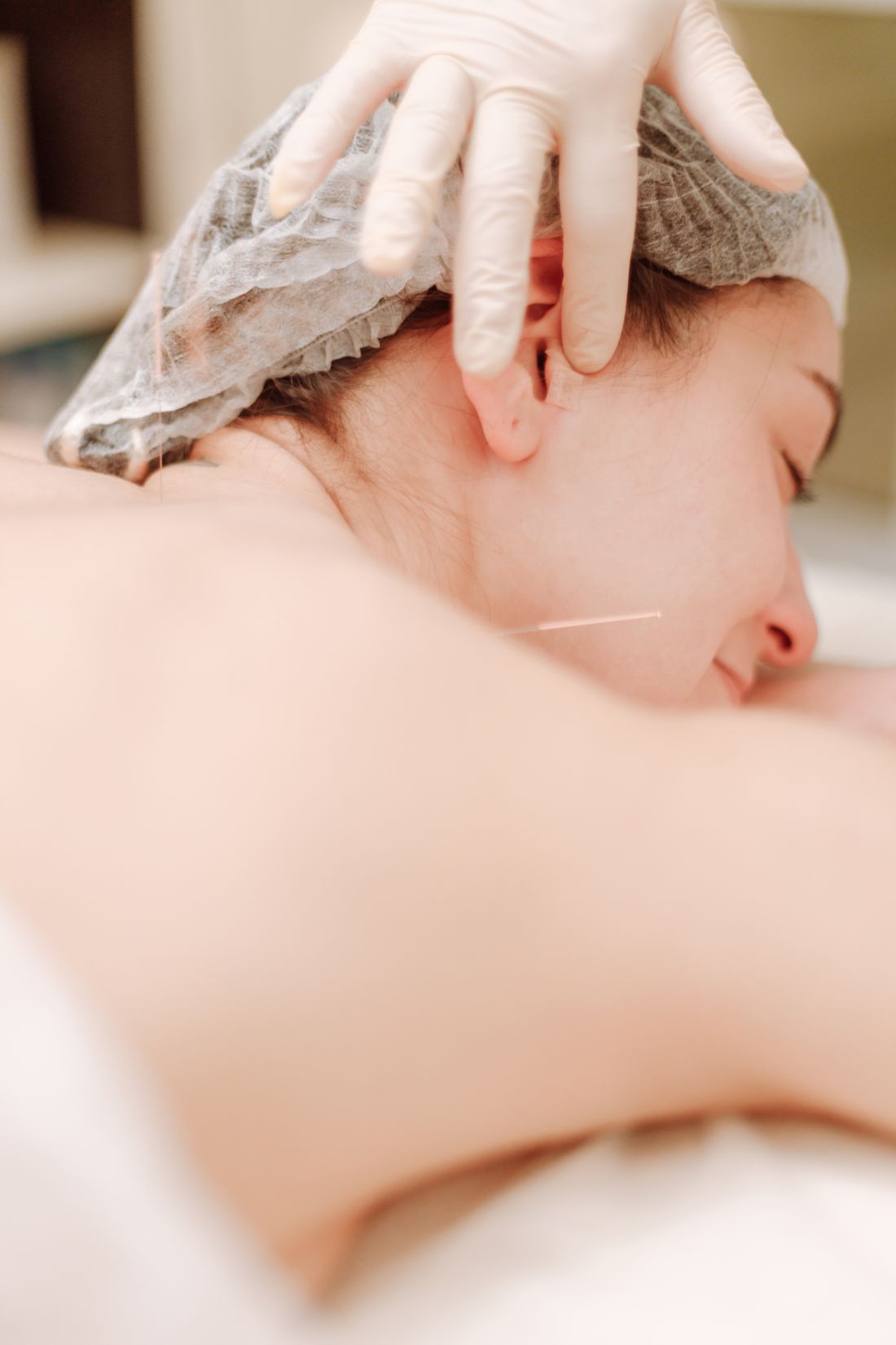 Sessao de acupuntura e relaxamento, detalhe das agulhas na pele