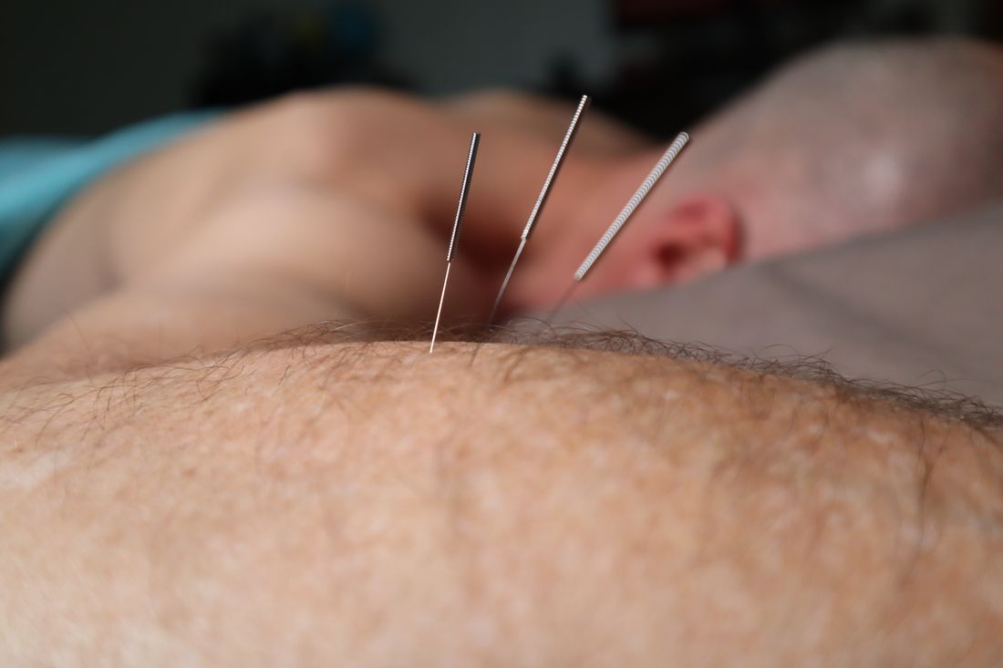 Agulhas de acupuntura aplicadas por terapeuta em tratamento clínico