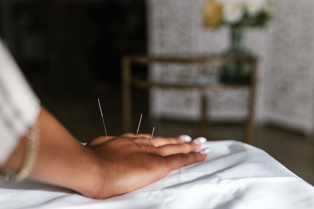 Agulhas de acupuntura aplicadas durante terapia de relaxamento